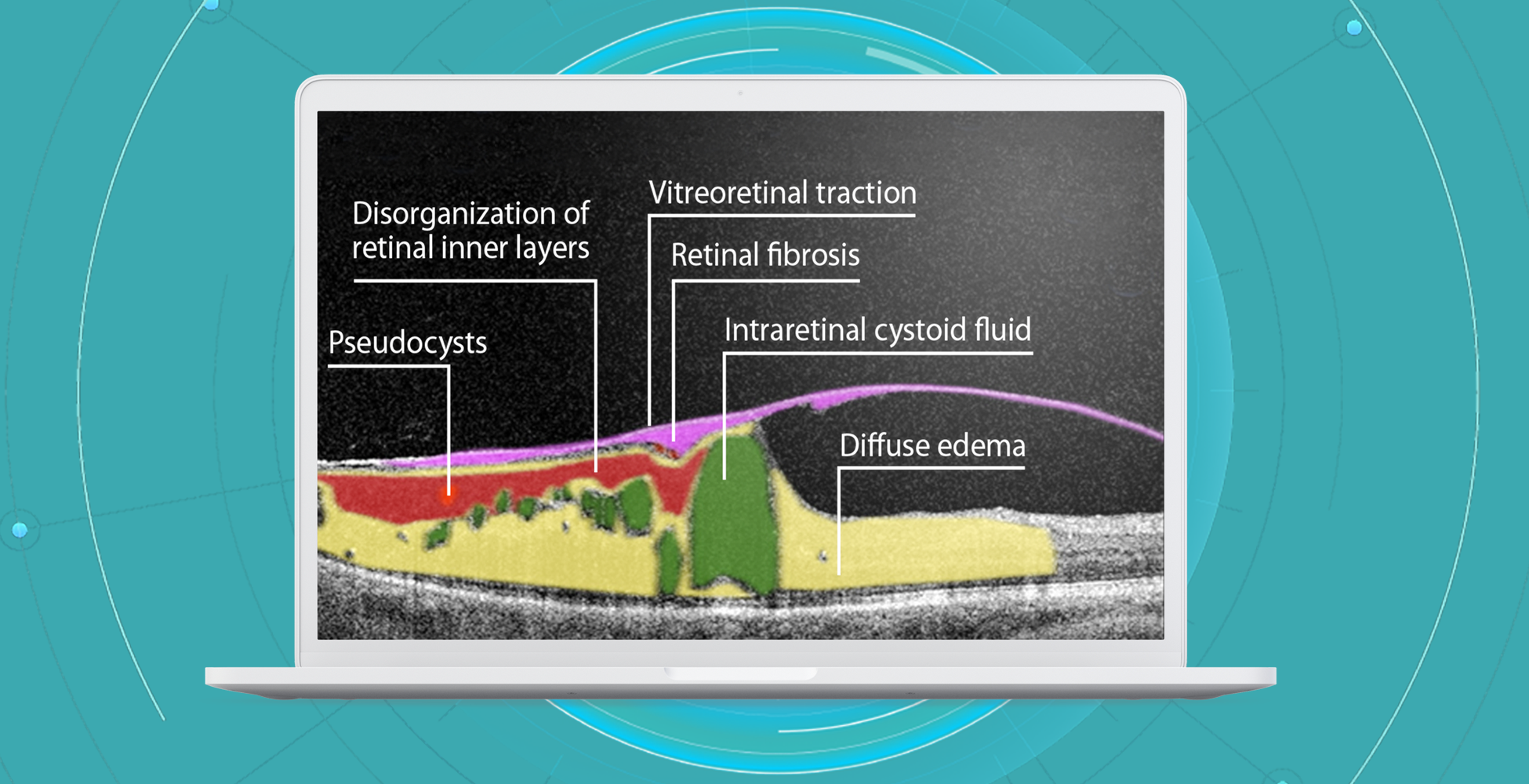 AI for Eye Care